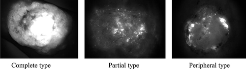 Figure 1 Three types of ICG fluorescence imaging.
