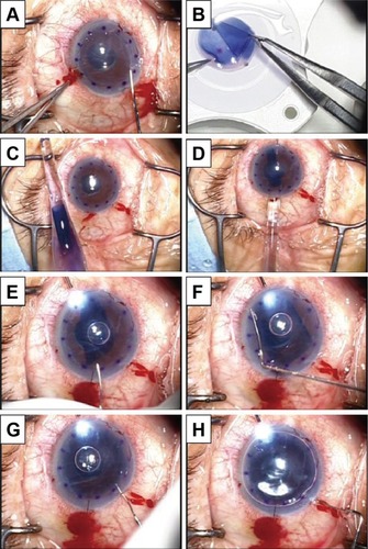 Figure 2 Surgical technique of endoillumination-assisted DMEK.