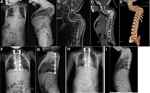 Figure 1 A female patient of 7 years old with C7-T9 vertebral tuberculosis and kyphosis. One-stage posterior approach internal fixation orthopedics was conducted followed by two-stage anterior approach lesion removal with additional bone grafting. (A and B) The preoperative whole spine frontal and lateral x-ray showed cervicothoracic segmental kyphosis, and obvious C7-T9 localized lateral kyphosis. (C) The preoperative MRI indicated the destruction of the C7~T9 vertebral body and intervertebral disc, a small amount of abscess formation in the paravertebral area, and a change in the intervertebral disc signal. (D and E) The preoperative CT and sagittal 3D reconstruction suggested multiple bone destruction at C7-T9, with some of the bone edges becoming hyperplastic and sharp. (F and G) The whole spine frontal and lateral x-ray after the staged posterior-anterior combined surgery showed a good position of the internal fixation and a good sequence of cervicothoracic vertebrae. (H and I) The whole spine frontal and lateral x-ray one year after surgery showed good internal fixation and complete osseous fusion.