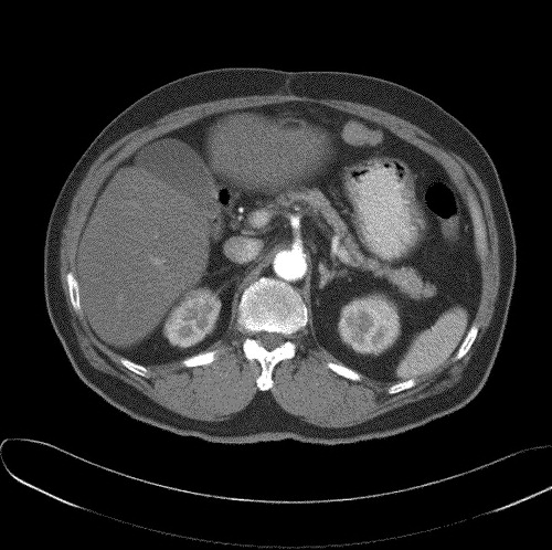 Figure 1.  CT scan in December 2002 showing new metastatic peritoneal nodule.