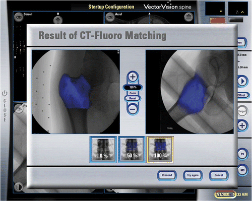 Figure 3. CT-fluoro matching was used for image-to-patient registration in Case 1. This involved the matching of preoperative CT images of a segmented bone region with two intraoperatively acquired fluoroscopic images, thus allowing minimally access registration of the preoperative CT images.