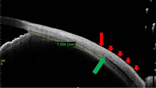Figure 8 A resected lateral rectus muscle. The anterior ocular coat again remained reasonably intact but the original insertion onwards (large red arrow) the posterior ocular coat showed a variably disturbed morphology (multiple small red arrows). The muscle specific hypoechoic area can be seen at 7.5 mm from angle (green arrow).
