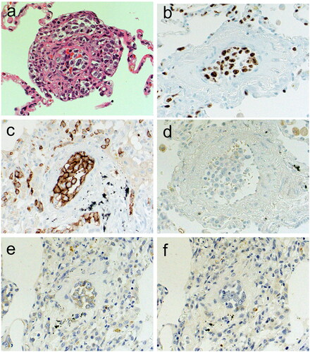 Figure 3. Histopathological findings of lung tissue in autopsy. (a) Hematoxylin and eosin, (b) Ki-67 (MIB-1), (c) CD20, (d) CD3, (e) ISH-kappa, (f) ISH-lambda. Large atypical lymphoid cells with an intravascular pattern were observed. MIB-1 index of neoplastic cells was 80%. These neoplastic cells were CD20+, CD3−, in situ hybridization kappa+ and in situ hybridization lambda-negative.