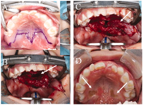 Figure 4. The second operation. (A) Design of the second operation. A left BMMF for soft palate elongation on the nasal side and a skin graft (SG) for soft palate elongation of the oral side were designed. (B) Soft palate elongation on the nasal side. A space occurs after posterior elongation (white arrow). (C) The space is filled by the left BMMF (white arrow). (D) One year after the second operation. Engrafted SGs (white arrow).