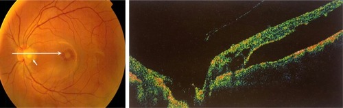 Figure 1 Color fundus photo and optical coherence tomography, showing optic disk pit (white arrows) and macular elevation.