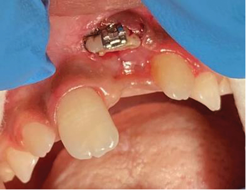 Figure 5. Appointment 2 orthodontic button placement.