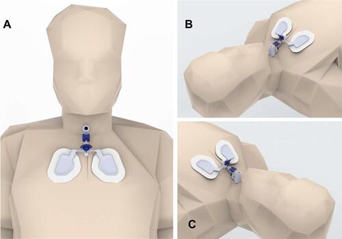 Figure 3 Conceptual model of DYNAtraq device evaluated in life-size human manikins. (A) Frontal plane view; (B) and (C) oblicuous plane view.