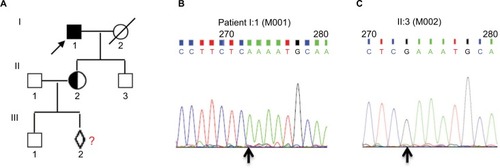 Figure 1 The pedigree of choroideremia and CHM gene mutation.Notes: (A) Pedigree of choroideremia. (B) The proband (I:1) with CHM nonsense variant (CHM:NM_000390:c.C799T:p.R267X) is indicated by an arrow as a filled square, exhibiting a 799 C→T mutation at the first nucleotide position of codon 267 (R267X) in the exon 6 of the CHM gene locus (cga-tga). (C) The proband’s son (II:3) harbors normal DNA sequences. The carrier (II:2) is a female of proband’s daughter and is pregnant with a fetus (III:2) who underwent prenatal diagnosis to demonstrate whether the baby inherited a normal X-chromosome. All of the Sanger sequencing results in this study used reverse complementary sequencing of the gene. The black arrow shows the position of the point mutation. The primer pair of CHM-L and CHM-R was used for PCR amplification and primer CHM-R for Sanger sequencing.