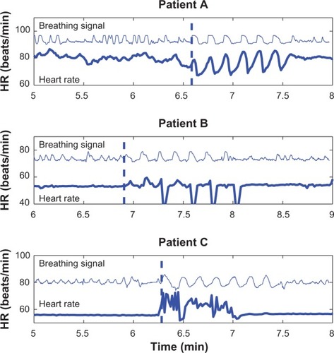 Figure 2 Recordings of heart rate (HR) variability patterns in three transthyretin amyloidosis patients during spontaneous and deep breathing, where the recordings were performed in the supine position. Patient A showed the normal response in HR during deep breathing, whereas patients B and C presented marked increases in HR variability because of cardiac arrhythmia during the test.