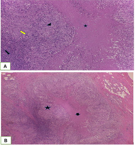 Figure 6 (A) Microscopic of the specimen showing casseous necrosis (*), granuloma that consists of Langhans giant cells (yellow arrow), epithelioid cells (black arrow head) and lymphocyte infiltration (black arrow) H&E 100x; (B) Granuloma (*) and casseous necrosis (arrow) H&E, 40x.