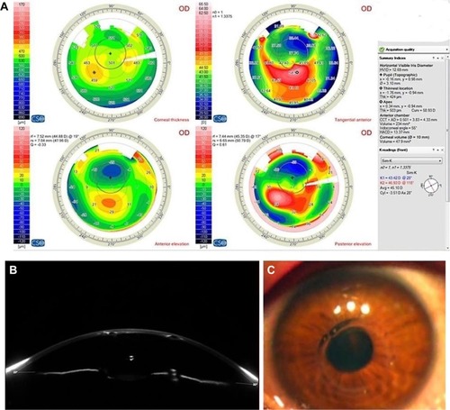 Figure 1 (A) Scheimpflug tomography by Sirius CSO showing decentered ring. (B) Scheimpflug image of the cornea showing decentered rings near toward the pupil. (C) Cornea view of the eye showing the Keraring crossing the pupil.