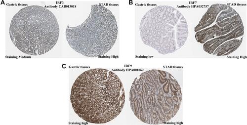 Figure 2 The protein level of IRFs in STAD (The Human Protein Atlas). The protein staining of IRF3 (A), IRF7 (B) and IRF9 (C) were STAD tissues and normal tissues.