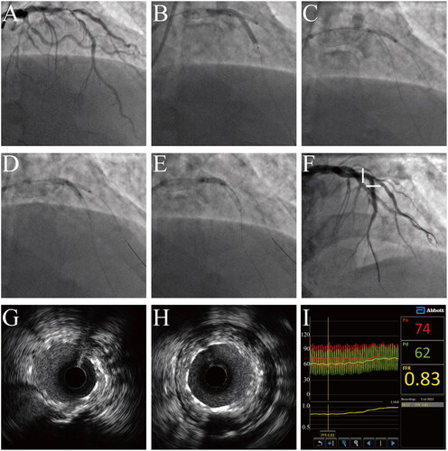 Figure 2. Step-by-step procedures of the hybrid technique in one representative patient. (A) Bifurcation lesion of left anterior descending artery (LAD) and first diagonal branch (D1). (B) Deployment of stent (10 atm) and DCB (10 atm). (C) Withdrawal of stent balloon but sustained inflation of DCB. (D) Post-dilation of bifurcation core (18 atm) simultaneously with DCB (10 atm). (E) Proximal optimization technique. (F) Final coronary angiography. (G) Distal and (H) proximal minimum stent cross sectional area images. (I) Fractional flow reserve test of D1. LAD: left anterior descending artery; D1: first diagonal branch; DCB: drug coated balloon.