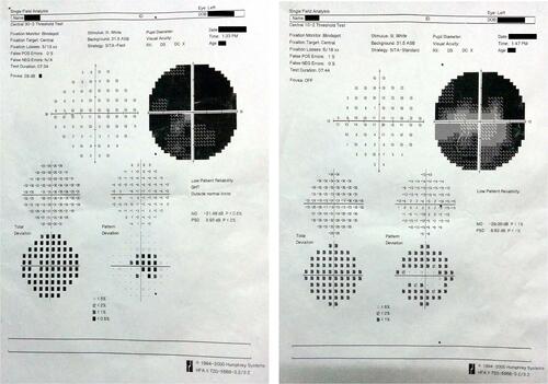 Figure 2 Humphrey’s visual field analyser charts of a patient with cup-disc ratio 0.9 showing generalized depression in 30–2 visual field charting and absence of macular splitting in 10–2 visual field charting in left eye.