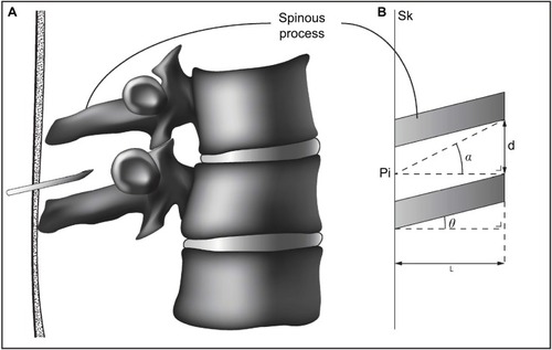 Figure 1 The adopted geometrical model: two adjacent spinous processes represented by two parallelograms.