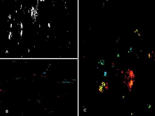 Fig. 3.  Calcium oxalate crystals in urine observed under confocal laser scanning microscope. (A) Needle-like appearance of calcium oxalate crystals. Monohydrate crystals are visualized (B) in green and blue colors under different laser beams; and (C) dihydrate crystals with the characteristic symmetrical mussel-shaped appearance are visualized in red and yellow.