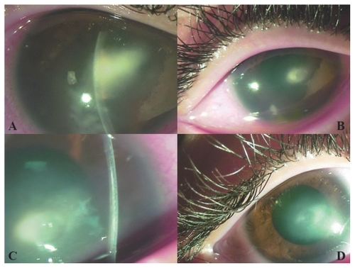 Figure 1 Appearance of case 1 (A) at initial presentation, (B) 2 weeks after crosslinking, (C) 2 weeks after crosslinking (note the stromal demarcation line due to crosslinking, adjacent to the abscess), and (D) 2 months after crosslinking.