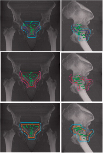 Figure 4. Digital reconstructed radiograph showing the spatial distribution of all local relapses with respect to the different CTVs and their respective PTVs: EORTC (top), RTOG (middle), FROGG (bottom).