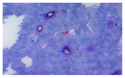 Figure 1. Detection of vascular mimicry in prostate cancer tissues by using CD31-PAS dual staining. The VM channel (red arrow) is formed by tumor cells. There are red blood cells in the center of the channel. PAS-positive substance (rose red) lines the channel and forms a basement membrane-like structure. The absence of necrosis and hemorrhage in the tumor tissue near the VM channel is seen. Endothelium-dependent vessels (blue arrows) are lined by endothelial cells, which are stained by CD31 (brown). Original magnification: × 400.