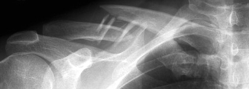 Figure 1. A typical displaced midshaft fracture with a displacement of more than 1 bone width, some degree of shortening, and several intermediary fragments.