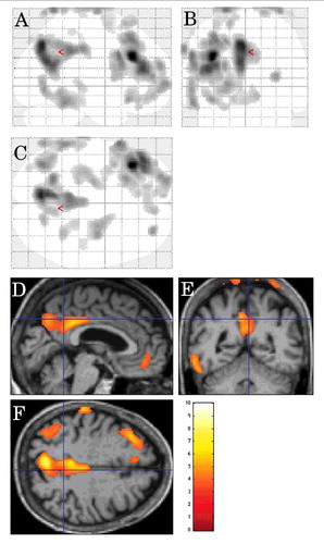 FIGURE 1. SPM showing decreased FDG-PET metabolism (using a stringent level of significance of p<0.001 and an extent threshold of 100 voxels) in the left lateral frontal cortex and the left mesial parietal cortex, and to a lesser degree the right mesial parietal cortex left lateral posterior temporal cortex in CJD patients in comparison to controls.