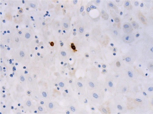 Figure 1 Photomicrograph showing mast cells (stained brown) within the decidua (mast cell tryptase immunohistochemistry, original magnification ×400).