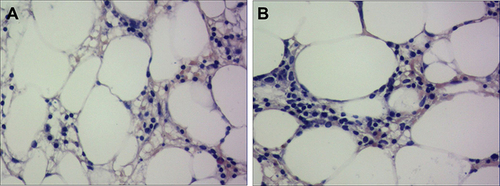 Figure 2 Pathological picture of bone marrow tissues from this case ((A) 200×; (B) 400×).