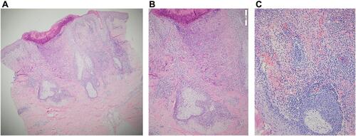 Figure 2 (A) Skin biopsy showing perivascular and perifollicular inflammatory cell infiltration with numerous eosinophilic and neutrophilic infiltrate in the follicular infundibulum and follicular spongiosis. (Hematoxylin and eosin; x40), (B) The follicles showed exocytosis of both lymphocytes and eosinophils. Epidermal necrosis with underlying neutrophilic and eosinophilic dermolysis was also noticed. (Hematoxylin and eosin; x100), (C) Vasculitic changes with migration of eosinophils and neutrophils through the vessel wall with mild luminal intramural fibrin deposition. (Hematoxylin and eosin; x 200).