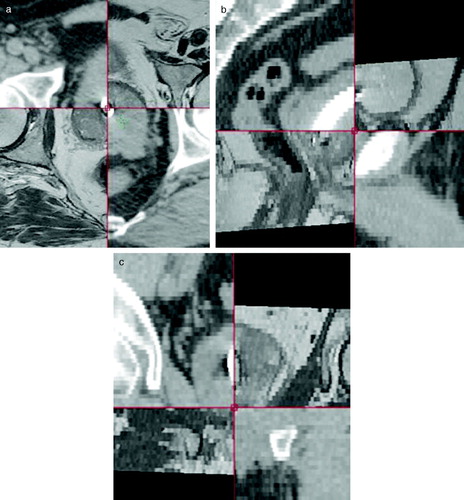 Figure 3.  Co-registered MR and CT scanning. Each image is divided in four quadrants. Counting clockwise the first and third quadrant is the MR image. The second and fourth is the CT image. The stent show up as a white structure on CT. Notice that partial volume effect increase the apparent size of the stent. On MR the stent show as a black (void signal) structure. The co-registration is shown in three planes a) axial b) sagital and c) coronal.