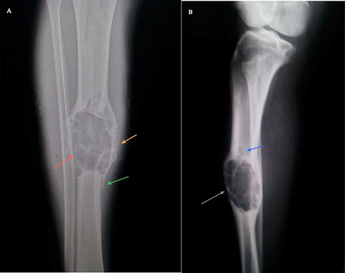 Figure 1 (A), Anteroposterior (AP) radiograph of the right tibia showing a lytic expansile lesion in the mid-diaphysis (indicated by a red arrow). Adjacent to this lesion, cortical irregularities are noted (Orange arrow), along with a solid type of periosteal reaction (green arrow). (B), Lateral radiograph of the same leg, further illustrating the expansile lytic lesion (gray arrow) and an adjacent lytic satellite lesion (blue arrow).