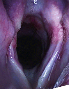 Figure 1. Intraoperative image of the larynx of a dog included in this study after VAUCAL.
