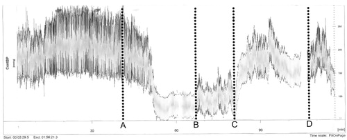 Figure 1. Diagram showing the continuous BP-measurements of the cuff-less Finapress Finometer® BP-device. A: Spontaneous initiation of breathing exercises by the patient. B: The patient starts to report increasing discomfort from the finger-cuff. C: The nurse conducts a single BP-measurement using the upper arm cuff. D: The nurse re-enters the room and informs the patient that the measurements will be finished soon.