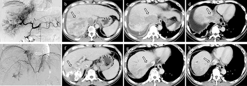 Figure 4 Hepatic artery (arrow, a) angiography showing feeding IVC/RA TT; Contrast-enhanced CT showed a huge hepatocellular carcinoma nodule (arrow, b), together with HVTT (arrow, c) and IVCTT (arrow, d); Right inferior phrenic artery (arrow, e) angiography showing feeding IVC/RA TT; CT images after combined treatment showed that large amounts of iodized oil were deposited in the primary lesion (arrow, f) and IVC/RATT (arrow, g and h) with decreases in the sizes of the tumor and tumor thrombus. HVTT, hepatic vein tumor thrombus.