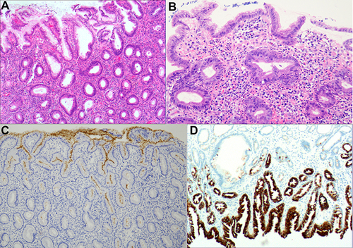 Figure 3 Proliferative disorder of the stem cells in the proliferative region. (A) The hyperplastic glands were mildly enlarged, with poorly defined cytoplasm, increased basophilia, and diffused acute and chronic inflammation of the interstitium; H&E staining, ×100. (B) The nuclei were elongated, mildly to moderately heterogeneous, with increased nuclear chromatin and small-to-medium-sized nucleoli in approximately 20% to 30% of the nuclei; H&E staining, ×200. (C) Positive for Hp, EnVision method, ×100. (D) Formation of the tubular and branched structures by significant cell proliferation in the deep gastric pit and isthmus of the gastric glands, as well as in the proliferating areas of the upper part of the glandular cervix. The proliferating glands were surface epithelial cells with the positive expression of MUC5AC; EnVision method, ×200.