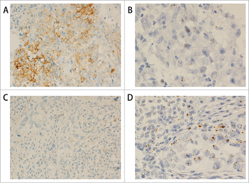 Figure 2. PDL1 protein and mRNA staining in triple negative breast cancer. (A) IHC shows PDL1 protein expression in the tumor cells (200x). (B) RNAscope shows PDL1 mRNA expression in the same case as in A (400x). (C) IHC shows negative PDL1 protein staining in the tumor cells (200x). (D) RNAscope shows positive PDL1 mRNA expression in the same case as in C (400x).