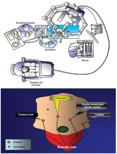 Figure 5 Positions of robot, surgical team, and trocars.