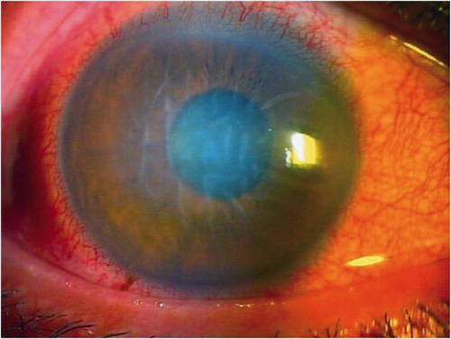 Figure 1.  Corneal endotheliitis, ciliary infection, diffuse corneal stromal edema, folds in Descemet’s membrane, and small pigmented keratic precipitates (KPs) before treatment.