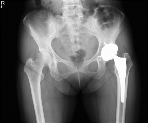 Figure 6. Although the varus angle of this stem is accurate to 3°, it appears to be ill-shapen on the X-ray. This demonstrates that accurate numerical values for the varus/valgus angle do not guarantee good results.
