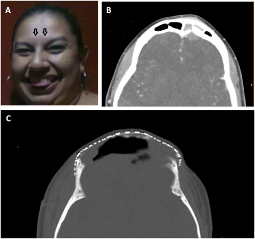 Figure 1. (A) Painful forehead lump (noted in the spring of 2013). (B) Computed tomography demonstrates a left frontal area mass extending through the sinus to the frontal lobe. (C) Status post multiple craniotomies and placement of the titanium mesh (2017).