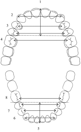 Figure 1. Dental arch measurements. 1. Upper arch length from the extreme labial surfaces of the incisors perpendicular to a line connecting the extreme mesial points of the first permanent molars. 2. Upper inter-canine width, between the crown tips. 3. Upper inter-premolar widths, between the palatal cusp tips of both first and second premolars. 4. Upper inter-molar width, between the mesiopalatal cusp tips of first permanent molars. Similarly: 5. Lower arch length, 6. Lower inter-canine width, 7. Lower inter-premolar widths, 8. Lower inter-molar width.