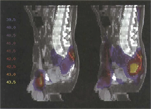 Figure 6. Temperature distribution (sagittal section, colourwash representation) after optimisation with Θ2 for tumour model 1 (high presacral), using the commercially available SIGMA-60 applicator (left). High temperatures suprapubically and dorsally. In comparison, temperature distribution using the upgraded triple-ring applicator (24 antennas according to Figure 1) is shown on the right. Temperature in the tumour has significantly increased. However, higher temperatures are distributed throughout a larger area of normal tissue. Numbers on the left represent temperatures [°C], corresponding to different colours.