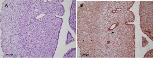 Figure 3. Cabergoline group; (A) Endometrium (hematoxylin-eosin × 200) (B) Endometrial stromal cell (black arrow); VEGFR-2 immunostained microvessel (red arrow) (× 200).