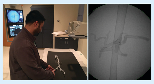 Figure 6. 3D printed model used for endovascular simulation.A resident practicing catheter skills (A), with corresponding fluoroscopic image of the training model (B).