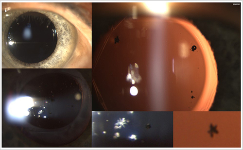 Figure 2 Slit lamp examination of patients with YAG pits. Note the defects which, depending on their number, size and position in relation to the optical axis, can have varying degrees of severity.