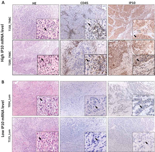 Figure 4. IP10 protein expression in breast tumors associates with high and low IP10 mRNA.The representative IHC images of tissue sections from two pairs of breast tumors exhibiting high (Panel A, T289 and T158) and low (Panel B, T115 and T054) mRNA levels of IP10. Left sections: hematoxylin and eosin (H&E) staining for histopathological topography examination of the selected FFPE breast tissue samples. Middle sections: IHC staining with anti-CD45 specific antibodies for evaluating tumor infiltrating lymphocytes. Right sections: IHC staining with of IP10 antibodies (see Materials and Methods for details). Black arrows show the tumor cells. White arrows show the TILs. The magnification is x10 for the whole section and x40 for the insertions.