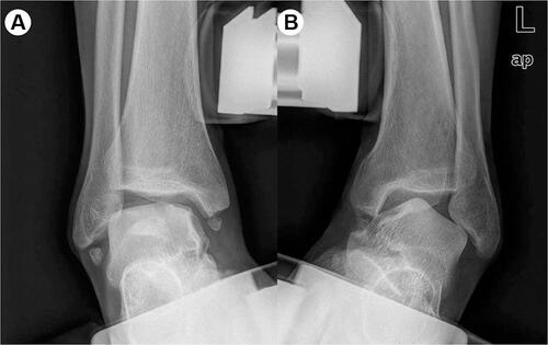 Figure 1 (A and B) Accompanying pathologies secondary to repetitive lateral ankle sprain.