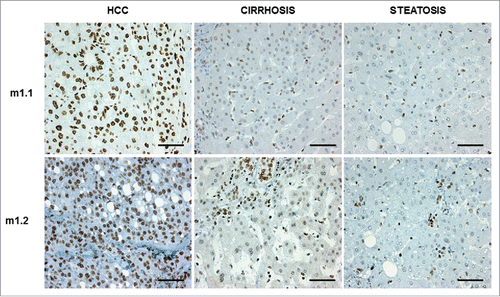 Figure 5. Representative pictures of immunostainings for macroH2A1.1 (m1.1) and macroH2A1.2 (m1.2) in samples from patients diagnosed with hepatocellular carcinoma (HCC), cirrhosis, and steatosis. Bar: 100 μM. All nuclei of tumor cells were positive for either m1.1 or m1.2. Positivity in hepatocytes of cirrhosis and steatosis was significantly lower.