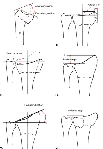 Figure 1 Radiographic measures of outcome in distal radius fractures. I) Dorsal angulation: The angle between the line which connects the most distal points of the dorsal and volar cortical rims of the radius (a) and the line drawn perpendicular to the longitudinal axis of the radius (b). Normally 11°–12° volar. II) Radial shift: This is a relative measurement, which is taken as the difference between the measurements of the fractured radius (c) and the normal, uninjured radius (d). III) Ulnar variance: Vertical distance between a line drawn parallel to the proximal surface of the lunate facet of the distal radius (e) and a line parallel to the articular surface of the ulnar head (f). Usually negative variance −1 mm. IV) Radial length: Distance between a line drawn at the tip of the radial styloid process, perpendicular to the longitudinal axis of the radius (g) and a second perpendicular line at the level of the distal articular surface of the ulnar head (h). Normally 11–12 mm. V) Radial inclination: Angle between a line perpendicular to the longitudinal axis of the radius (i) and a line joining the distal tip of the radial styloid and the distal sigmoid notch (j). Usually 21°–25°. VI) Articular step: Up to 2 mm is acceptable.