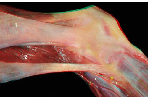 Figure 1 Flexed knee: iliotibial band (1), biceps femoris (2), fibular nerve (3), lateral gastrocnemius tendon (4), and sural nerve and ramifications (5).