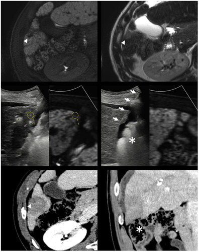 Figure 4. Successful ablation of a subcapsular tumor with nearby hepatic flexure of the colon in a 57-year-old male patient.A 1.3-cm subcapsular tumor with hepatobiliary phase defect (arrowhead, upper left) and mild T2 hyperintensity (arrowhead, upper right) is close to the hepatic flexure of the colon. With US-MR fusion guidance, two ICAEs were inserted into the peritumoral parenchyma in a parallel manner with an interelectrode distance of 2.0 cm (middle left). An MPN was inserted into the subcapsular parenchyma (arrows, middle right) for SPTM. Note that the hepatic flexure of the colon lies close to the peritumoral liver capsule even after artificial ascites infusion (asterisk, middle right). In the immediate (lower row) and one-month follow-up CT (not shown), the index tumor was surrounded by an ablation zone with sufficient margin (arrowhead, lower left). Nontarget injuries were not observed in the colon (asterisk, lower right) and other nearby structures.ICAE: internally cooled electrode with adjustable active tip length; MPN: multipurpose needle; SPTM: subcapsular parenchyma temperature monitoring; CT: computed tomography.